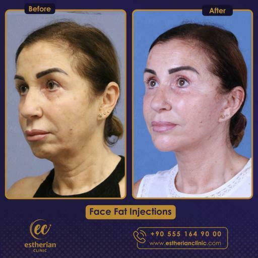FACE FAT INJECTIONS