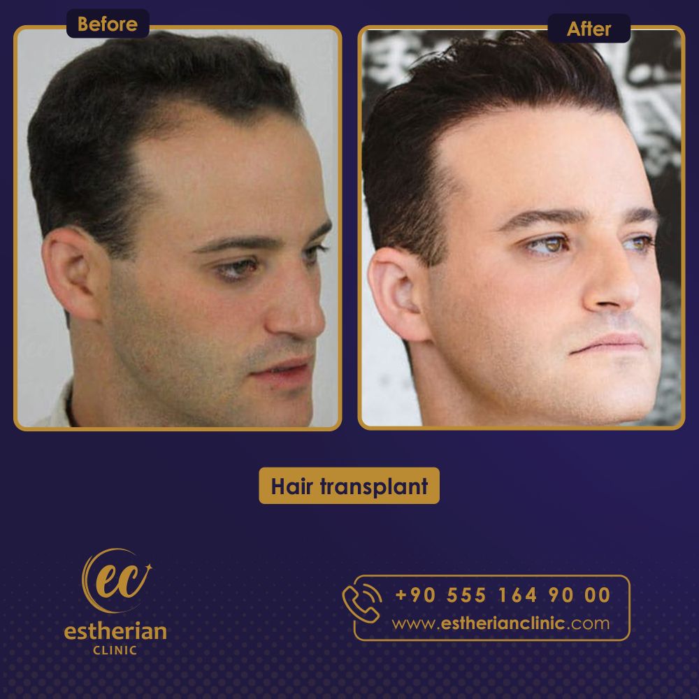 Fue hair transplant - Estherian Clinic